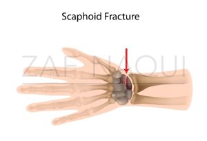 scaphoid fracture graphic_121783252