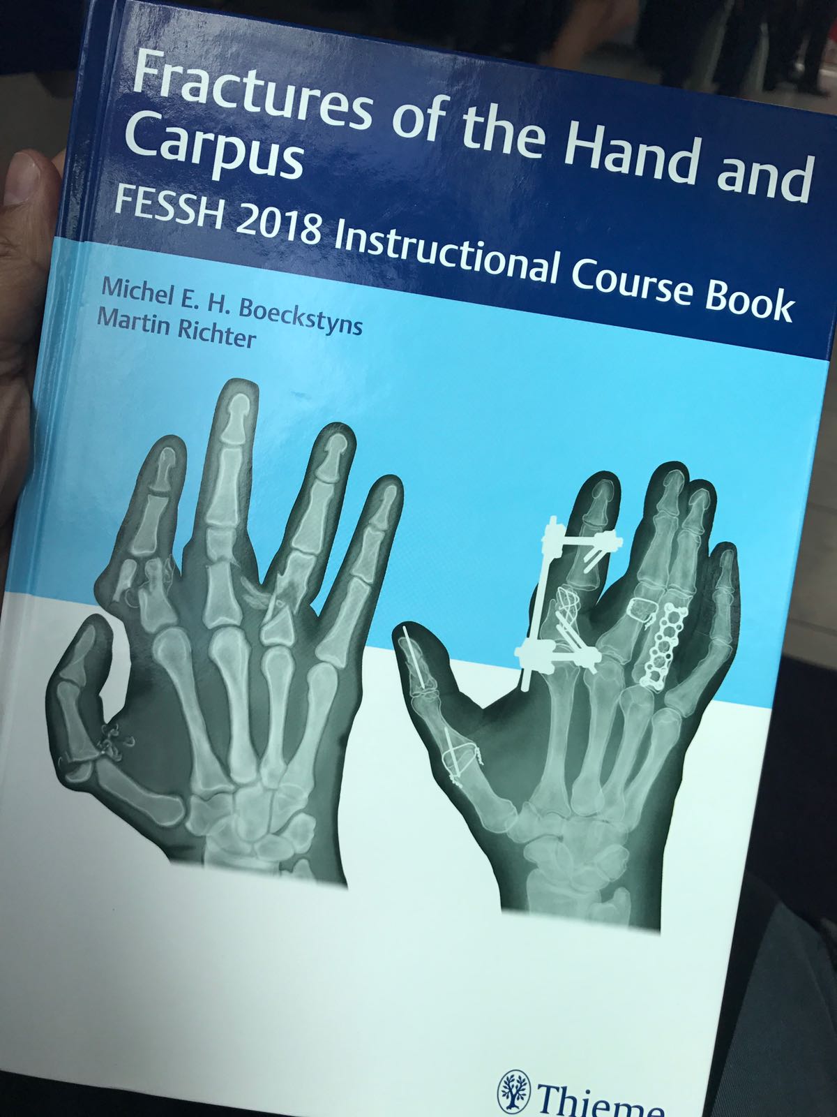 Publication of Book Chapter on Hand Fractures